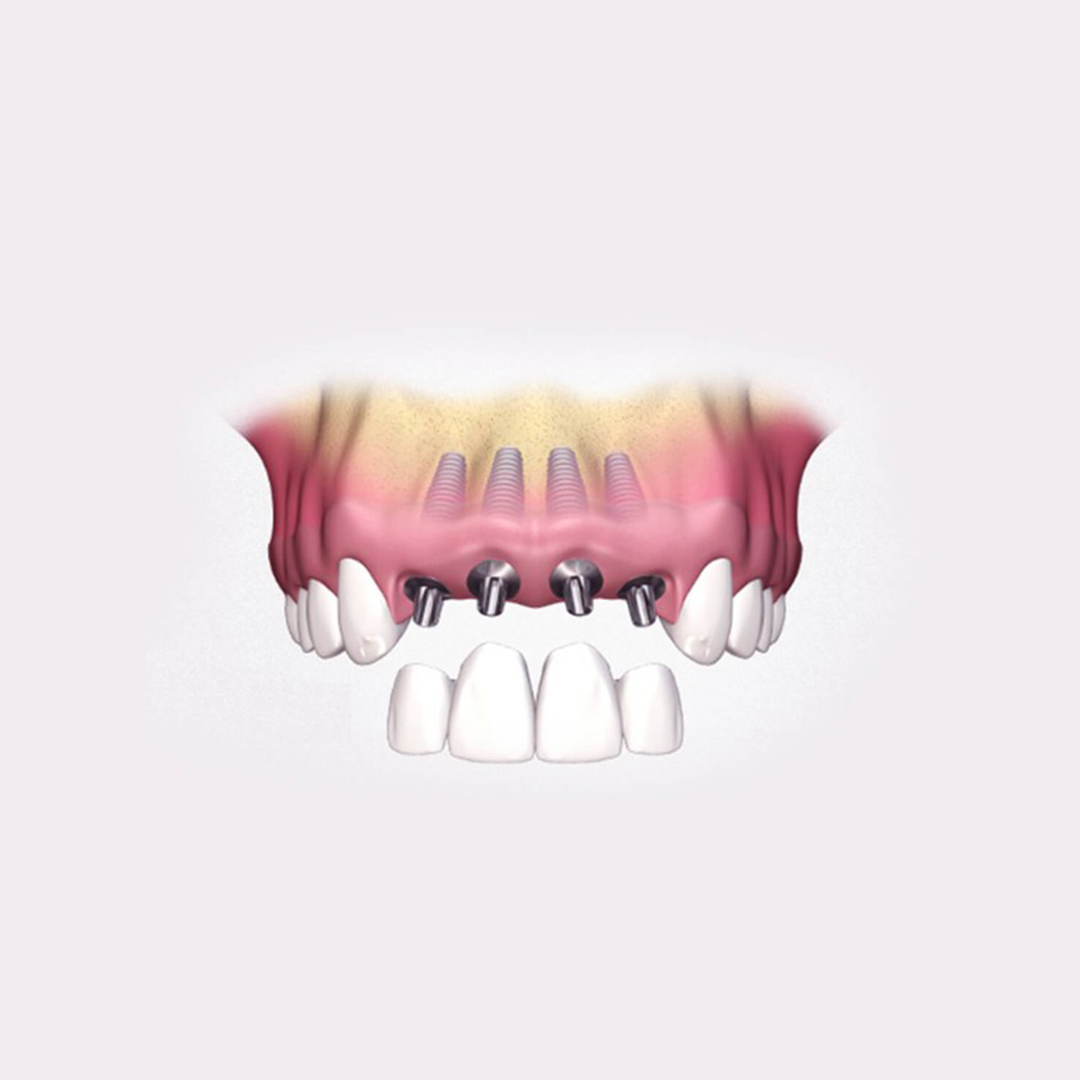 Імплантація передньої групи зубів
