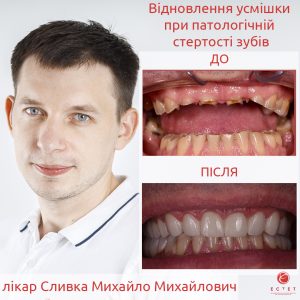 Відновлення усмішки при паталогічній стертості зубів