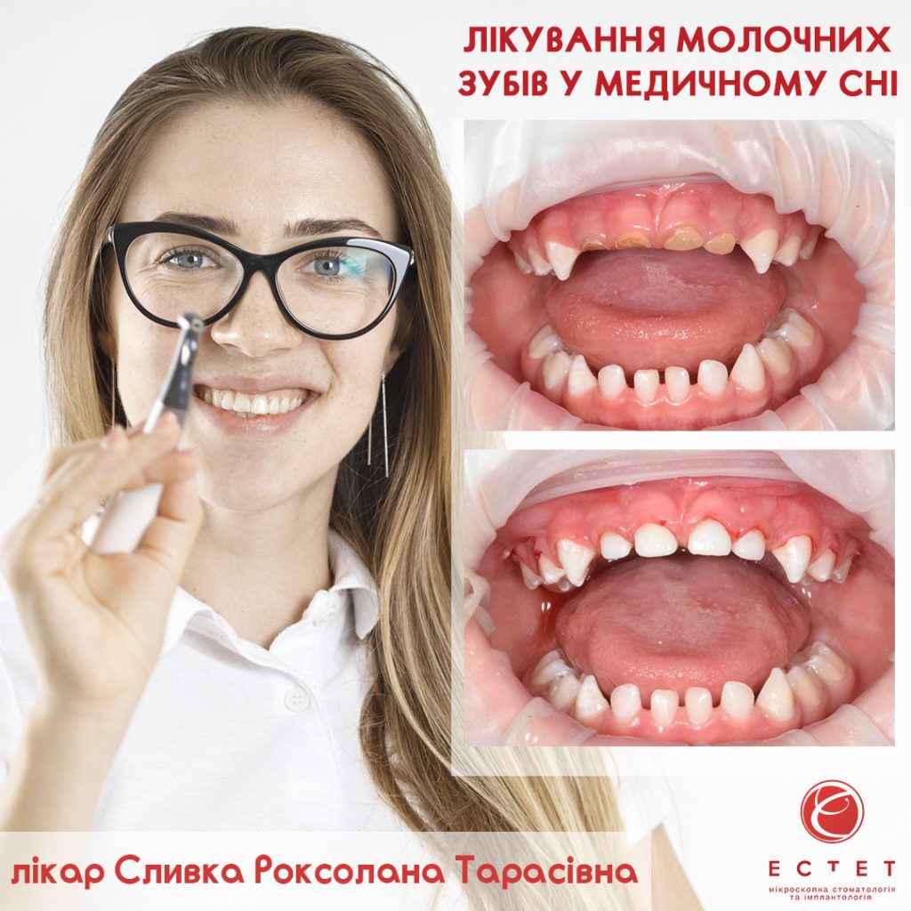 Сливка Роксолана Тарасівна - Лікування молочних зубів у дедичному сні