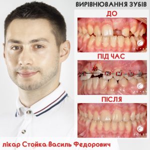 Стойка Василь Федорович вирівнювання зубів