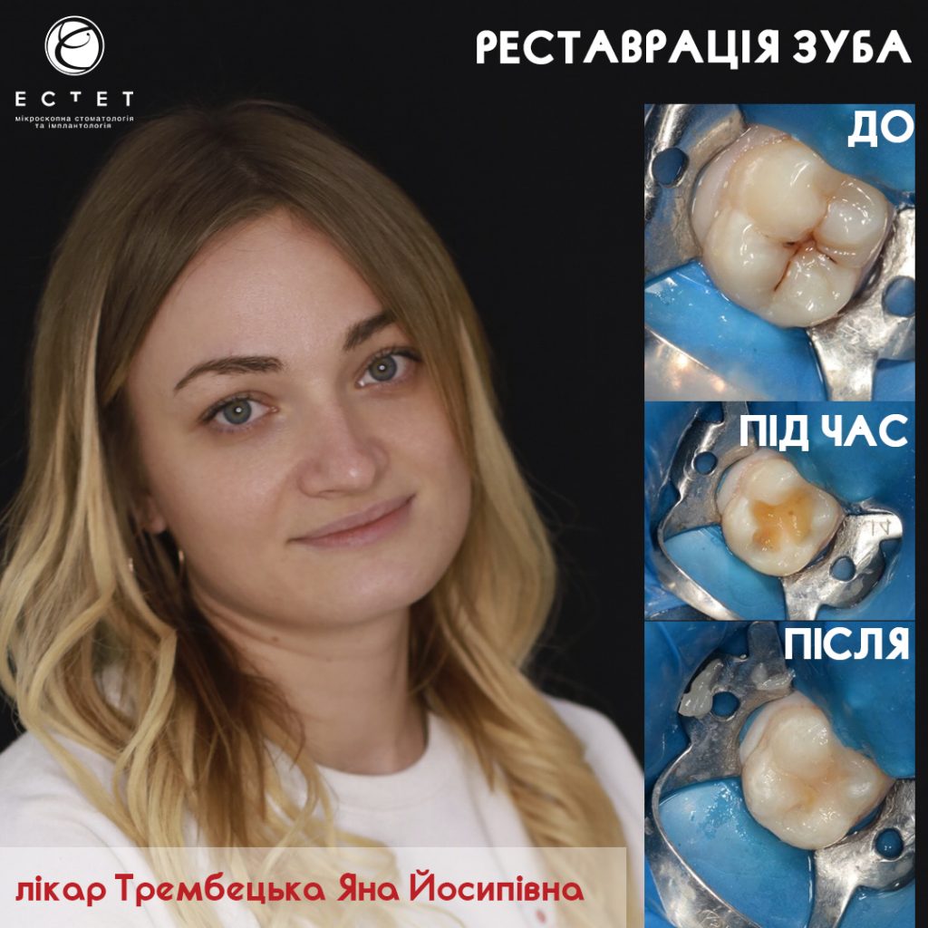Трембецька Яна Йосипівна - Реставрація зуба