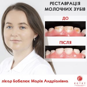 Бобелюк Марія Андріанівна - реставрація зубів