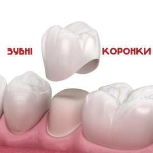 Зубні коронки на зуби