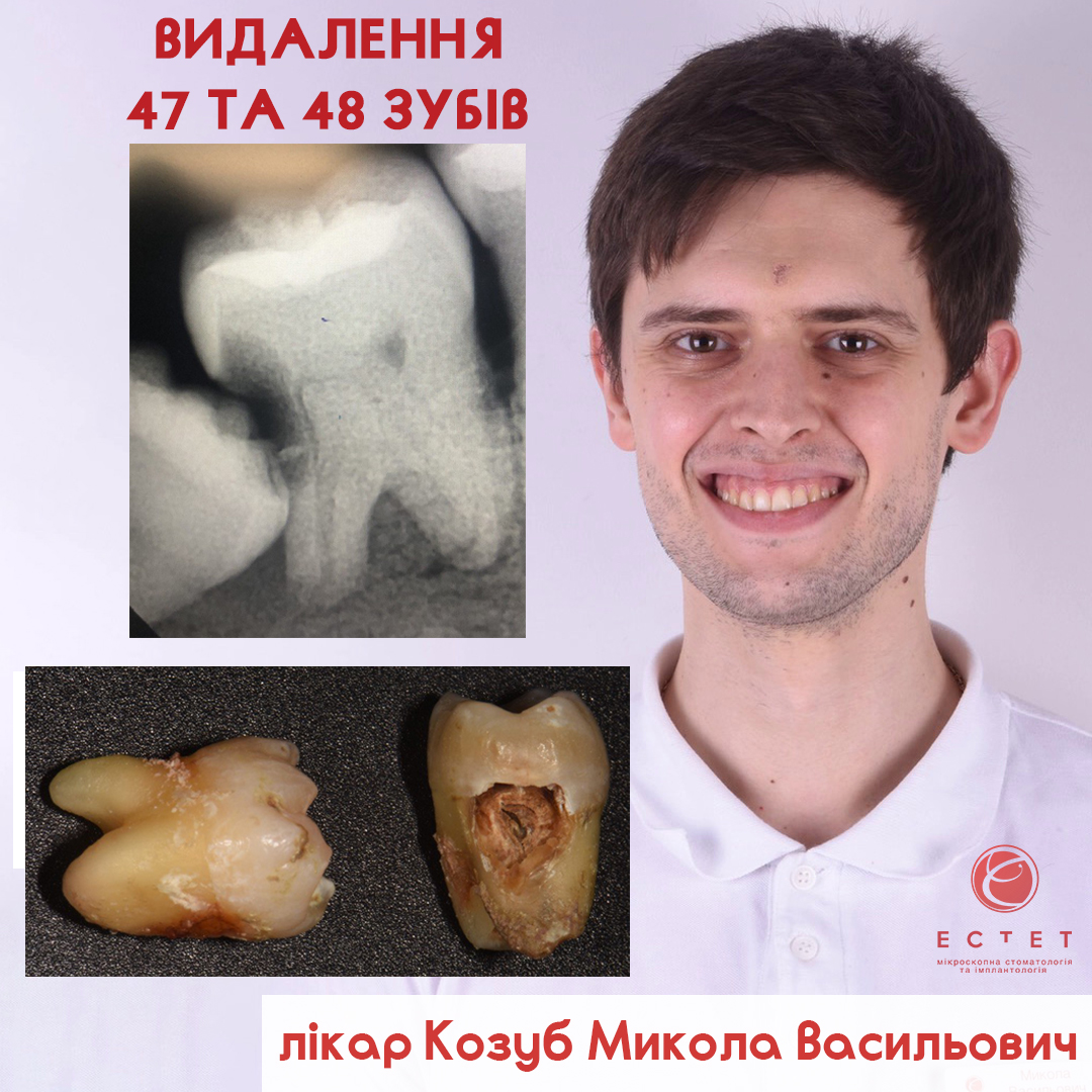 Козуб Микола Васильович видалення зубів