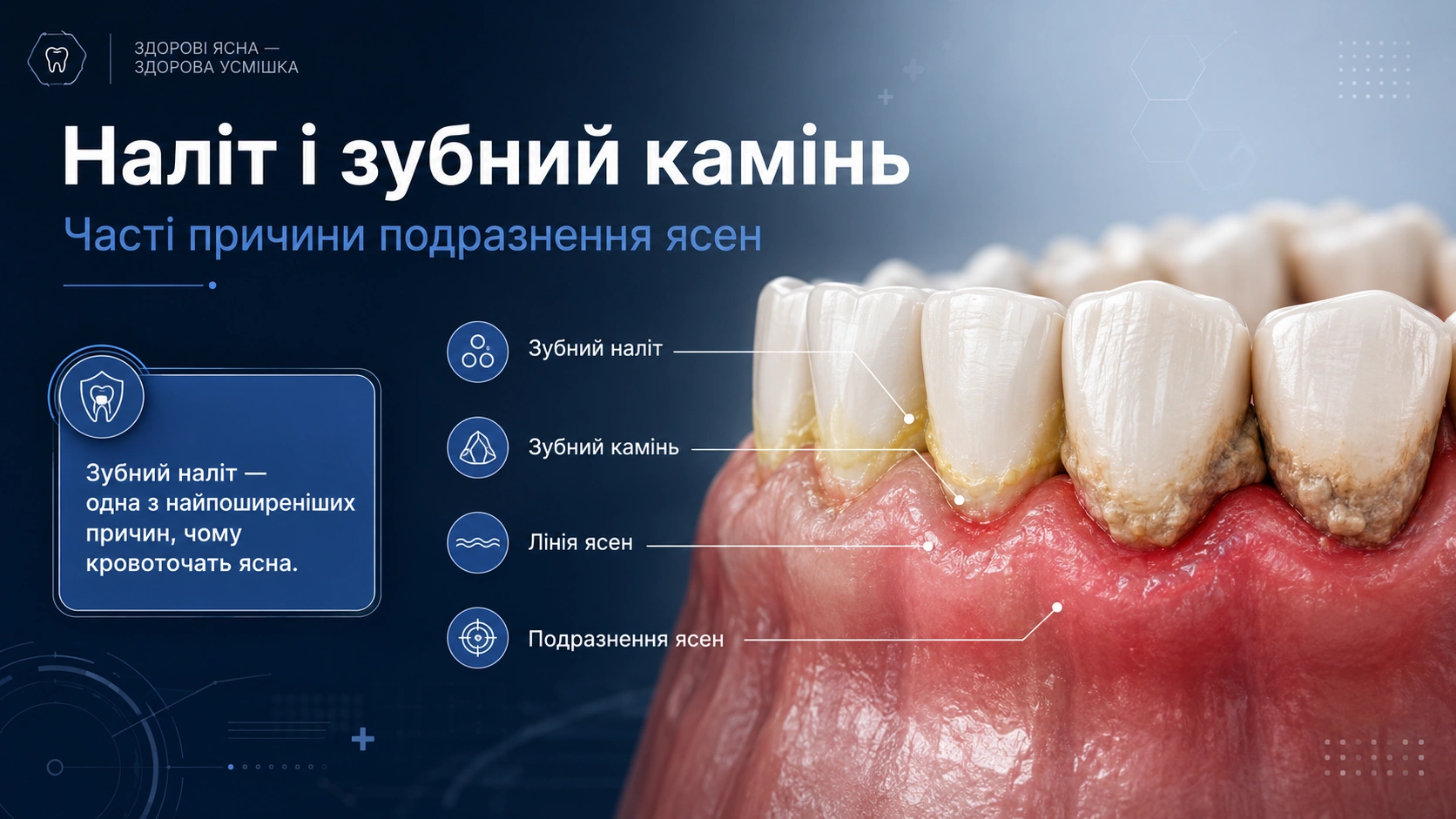 зубний наліт і камінь як причина кровоточивості ясен